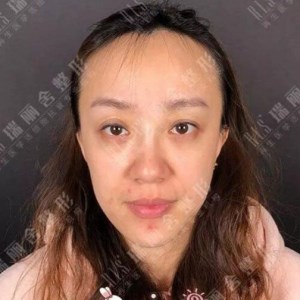 瑞麗舍整形馬君做的全臉自體脂肪填充，不錯呢~