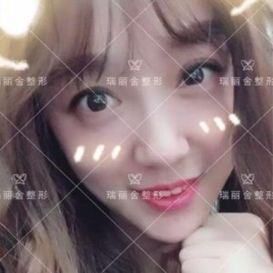 瑞麗舍整形馬君做的全臉自體脂肪填充，不錯呢~