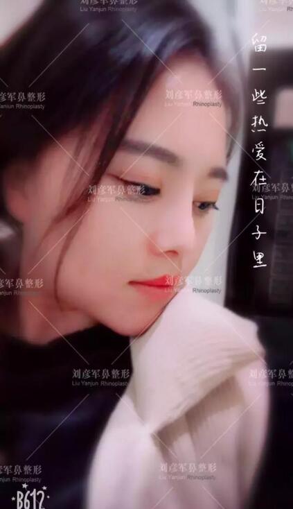 劉彥君隆鼻案例圖恢復記錄