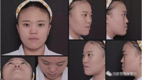 劉彥君隆鼻案例圖恢復記錄