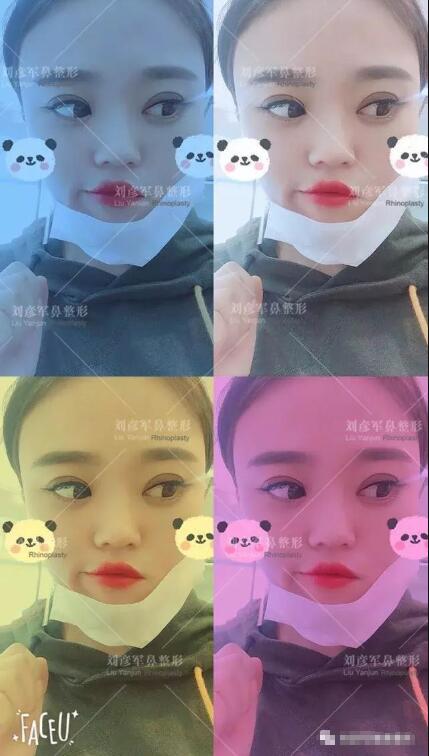 劉彥君隆鼻案例圖恢復記錄