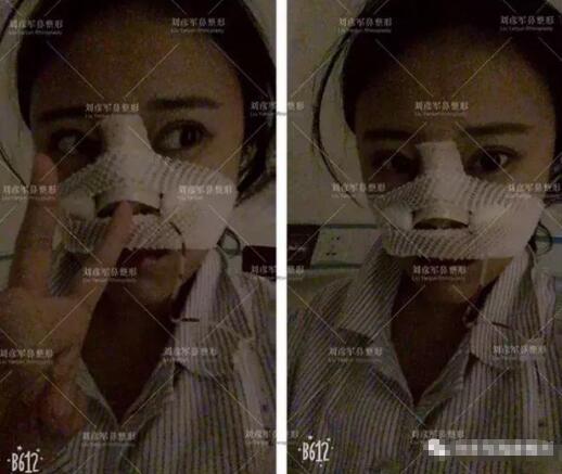 劉彥君隆鼻案例圖恢復記錄