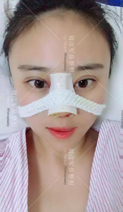 劉彥君隆鼻案例圖恢復記錄