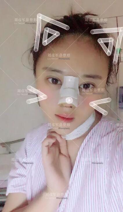 劉彥君隆鼻案例圖恢復記錄