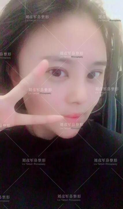 劉彥君隆鼻案例圖恢復記錄