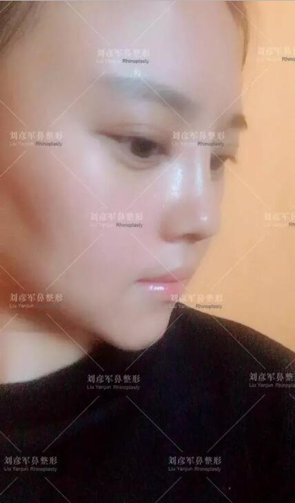 劉彥君隆鼻案例圖恢復記錄