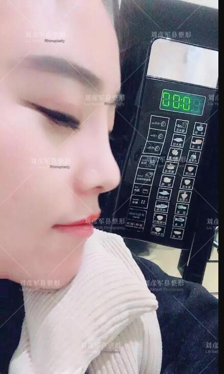 劉彥君隆鼻案例圖恢復記錄