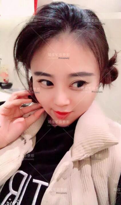 劉彥君隆鼻案例圖恢復記錄