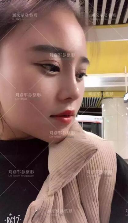 劉彥君隆鼻案例圖恢復記錄