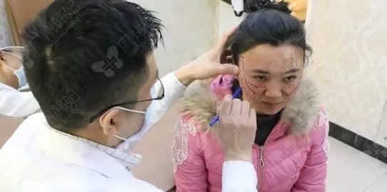 廣州韓妃美版超聲提拉和埋線提升提升日記一則，給你好看~