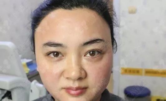廣州韓妃美版超聲提拉和埋線提升提升日記一則，給你好看~