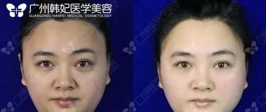 廣州韓妃美版超聲提拉和埋線提升提升日記一則，給你好看~