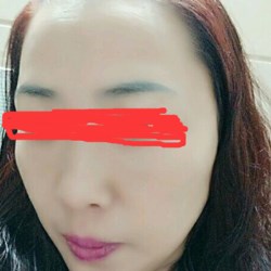 北京邦定張亞昆做的面部提升，果較為不錯(cuò)~