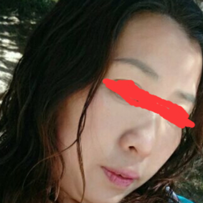 北京邦定張亞昆做的面部提升，果較為不錯(cuò)~