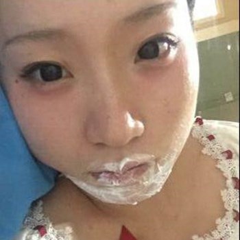 北京麗詩(shī)麗格楊明強(qiáng)玻尿酸豐唇半個(gè)月了，看看果~