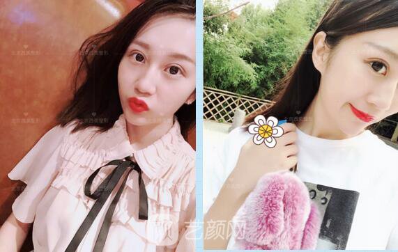 北京西美整形全切雙眼皮，徹底拯救我的大小眼