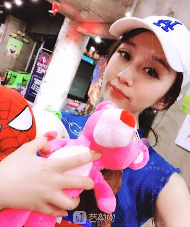北京西美整形全切雙眼皮，徹底拯救我的大小眼