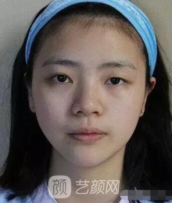 上海伊美爾港華醫(yī)院開(kāi)雙眼皮圖 大小眼的救星