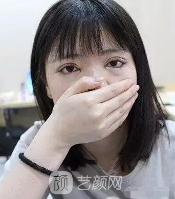 上海伊美爾港華醫(yī)院開(kāi)雙眼皮圖 大小眼的救星