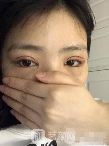 上海伊美爾港華醫(yī)院開(kāi)雙眼皮圖 大小眼的救星