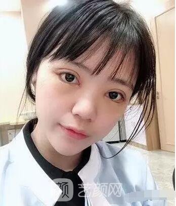 上海伊美爾港華醫(yī)院開(kāi)雙眼皮圖 大小眼的救星