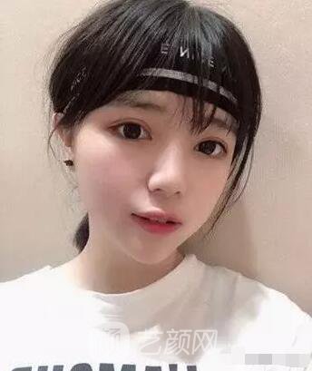 上海伊美爾港華醫(yī)院開(kāi)雙眼皮圖 大小眼的救星