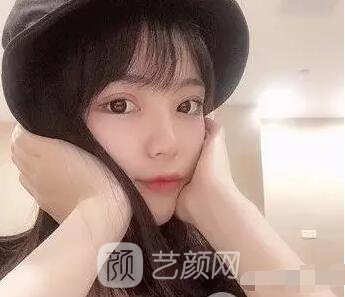 上海伊美爾港華醫(yī)院開(kāi)雙眼皮圖 大小眼的救星