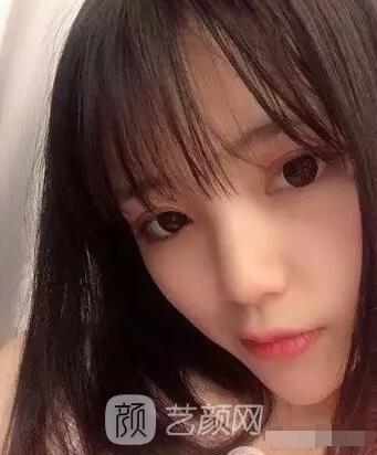 上海伊美爾港華醫(yī)院開(kāi)雙眼皮圖 大小眼的救星
