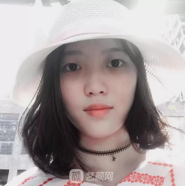 北京西美整形醫(yī)院全切雙眼皮真人案例圖|內(nèi)附恢復過程哦~