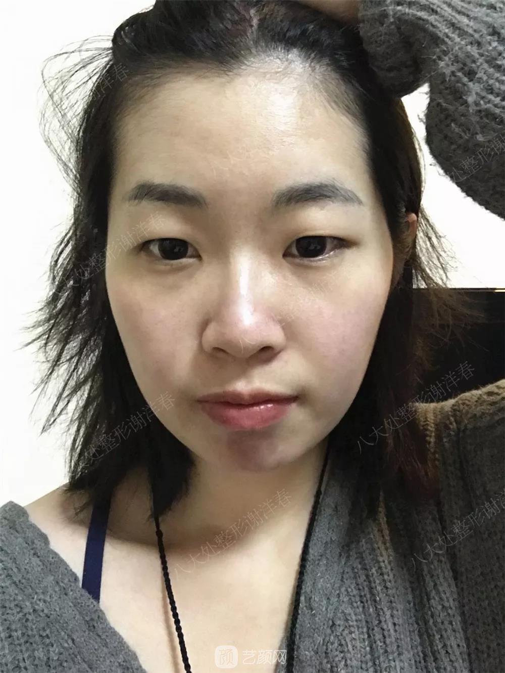 北京八大處割雙眼皮恢復過程，內附圖