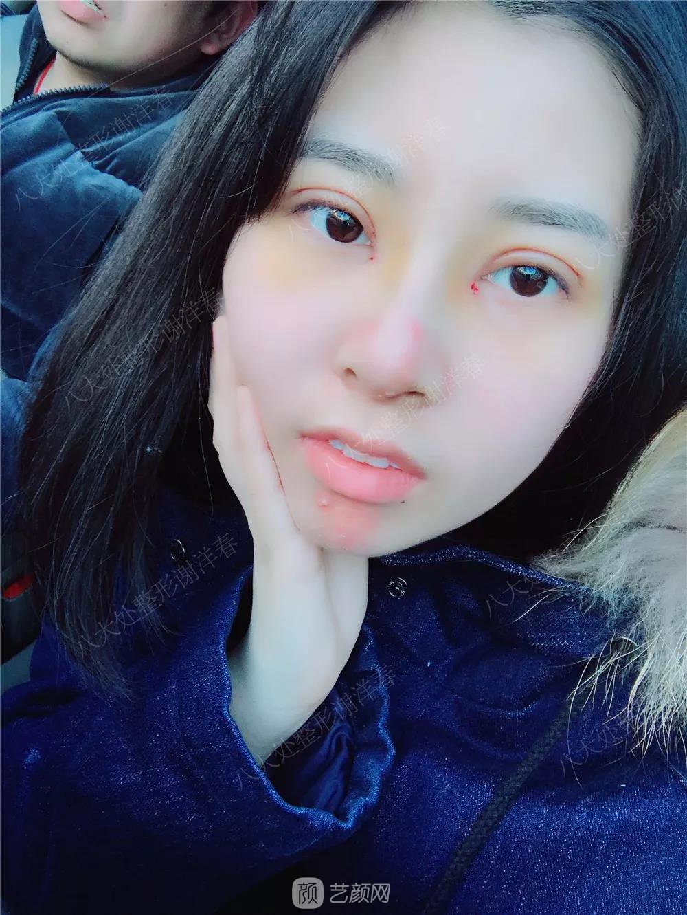 北京八大處割雙眼皮恢復過程，內附圖
