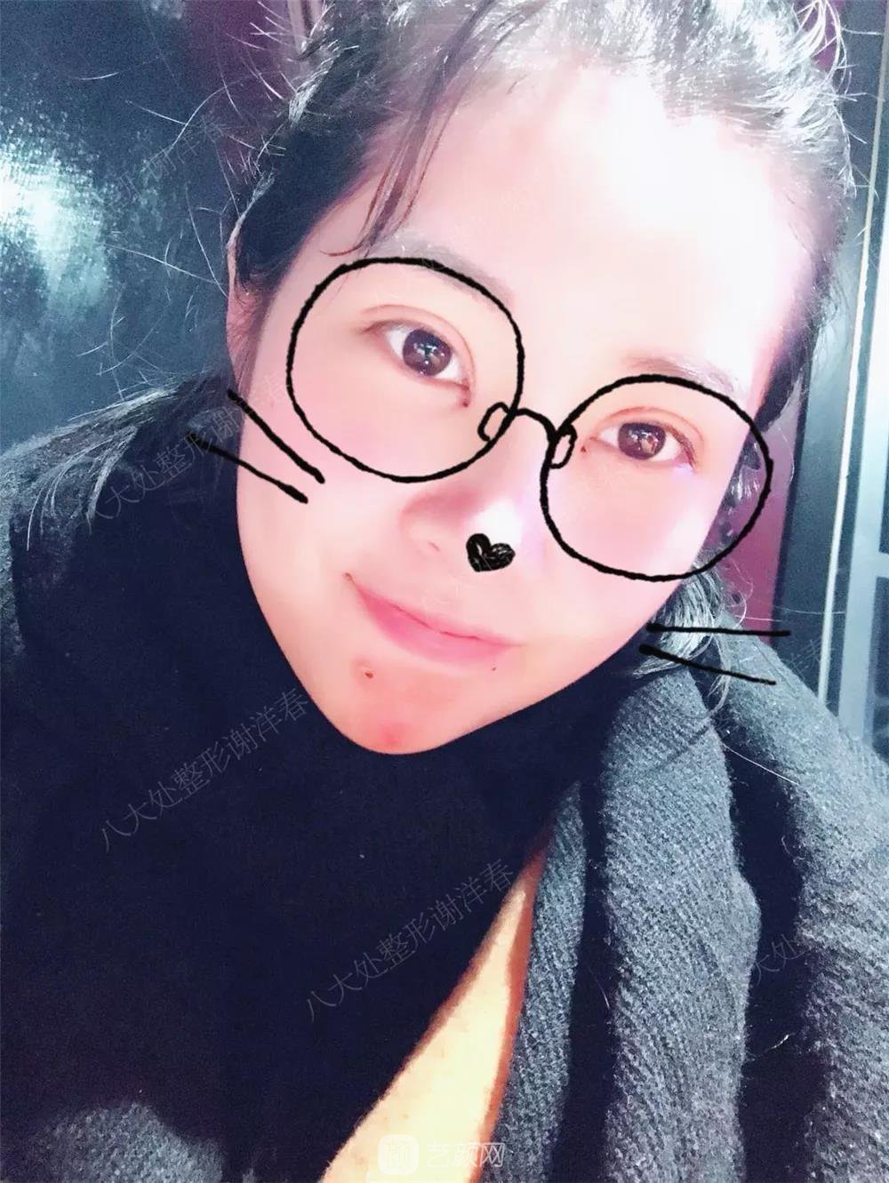 北京八大處割雙眼皮恢復過程，內附圖