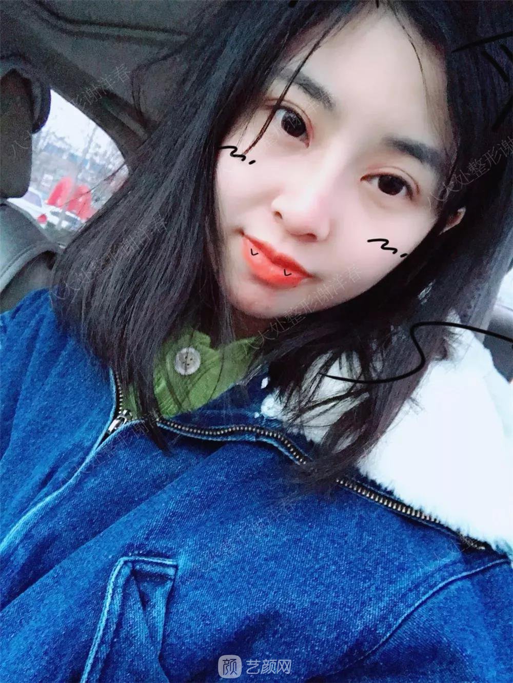 北京八大處割雙眼皮恢復過程，內附圖