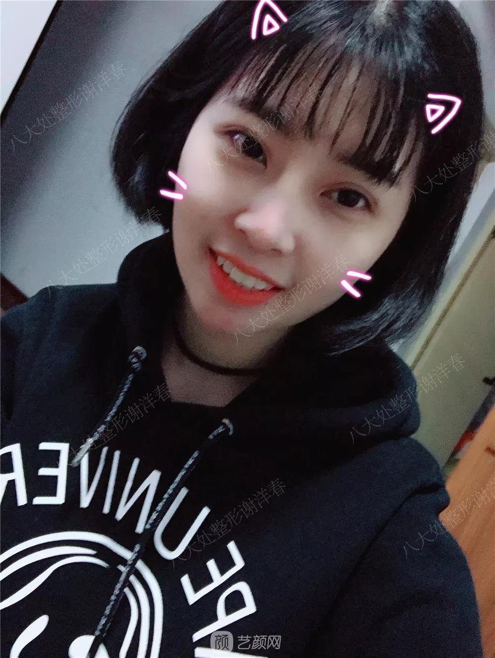 北京八大處割雙眼皮恢復過程，內附圖