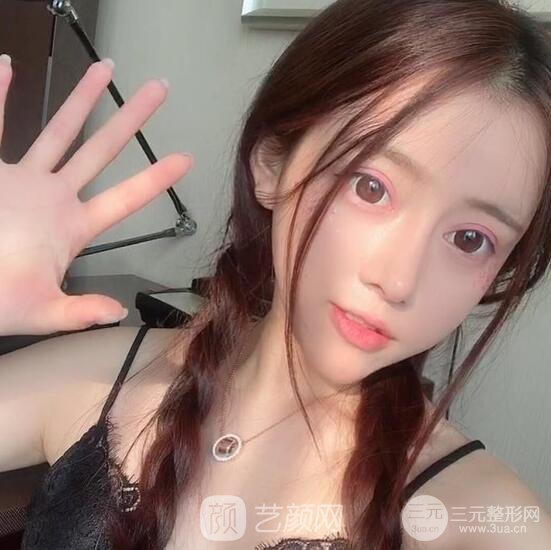 重慶原辰艾劍雄膨體隆鼻+雙眼皮案例分享~