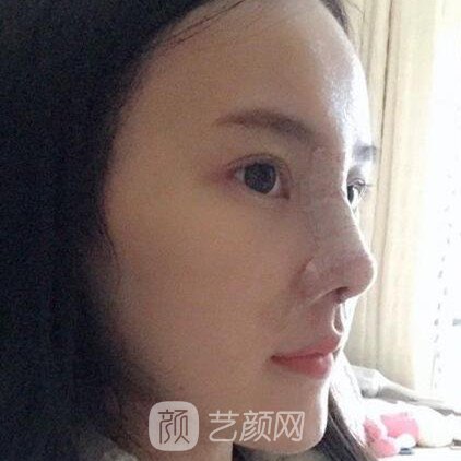 重慶聯(lián)合麗格王巖玻尿酸隆鼻三個(gè)月了，分享果照片~