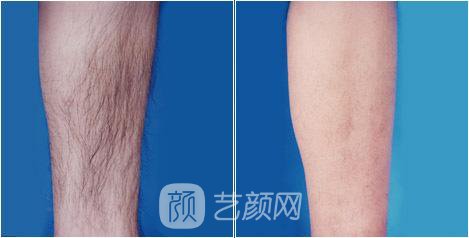 溫州激光脫毛一般要多少錢？