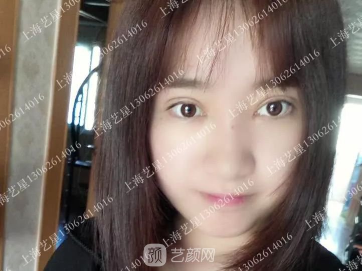 上海藝星割雙眼皮術(shù)后一個(gè)月恢復(fù)日記一則~