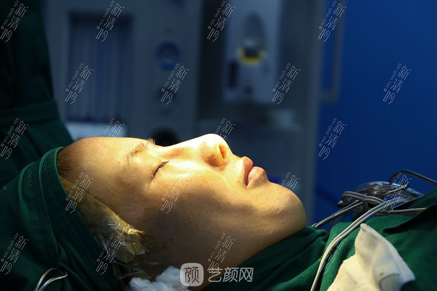 耳軟骨隆鼻果圖分享，術(shù)后~