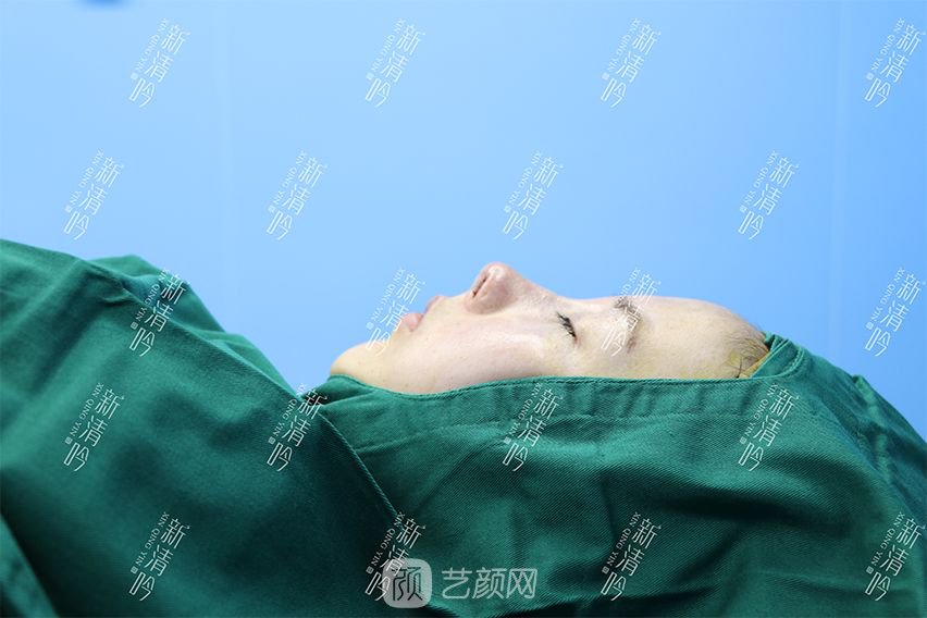 耳軟骨隆鼻果圖分享，術(shù)后~