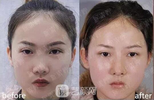 耳軟骨隆鼻果怎么樣？案例照片一覽~