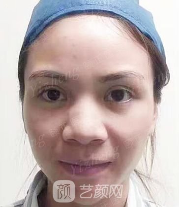 葫蘆島頤正夏秉成鼻部手術+SVF自體脂肪多方面部填充案例~