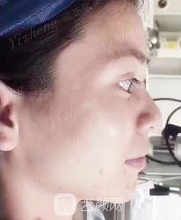 葫蘆島頤正夏秉成鼻部手術+SVF自體脂肪多方面部填充案例~