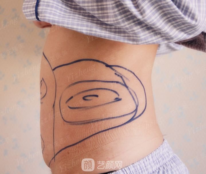 葫蘆島頤正夏秉成鼻部手術+SVF自體脂肪多方面部填充案例~