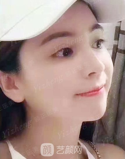 葫蘆島頤正夏秉成鼻部手術+SVF自體脂肪多方面部填充案例~