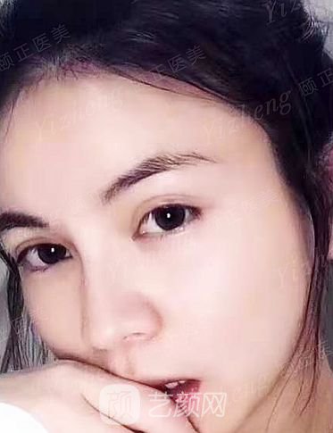 葫蘆島頤正夏秉成鼻部手術+SVF自體脂肪多方面部填充案例~