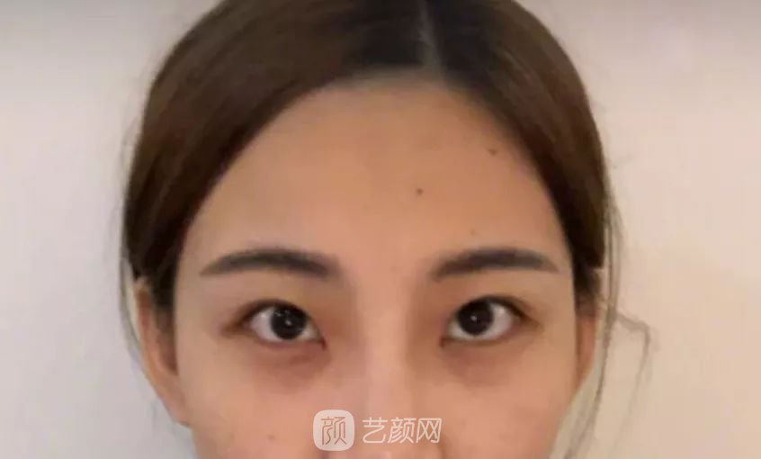 眼部手術(shù)一個月恢復(fù)日記，片分享~