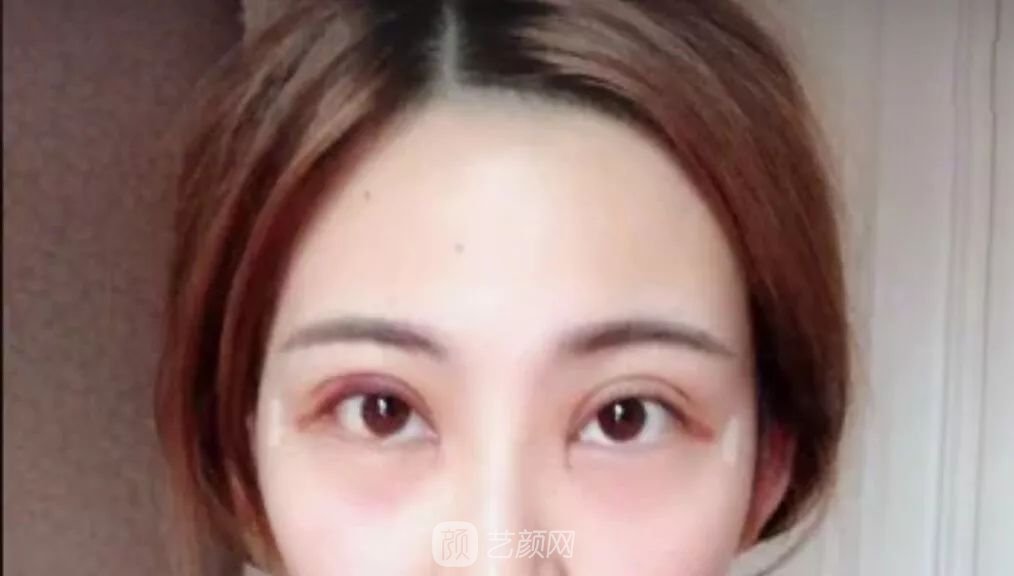 眼部手術(shù)一個月恢復(fù)日記，片分享~