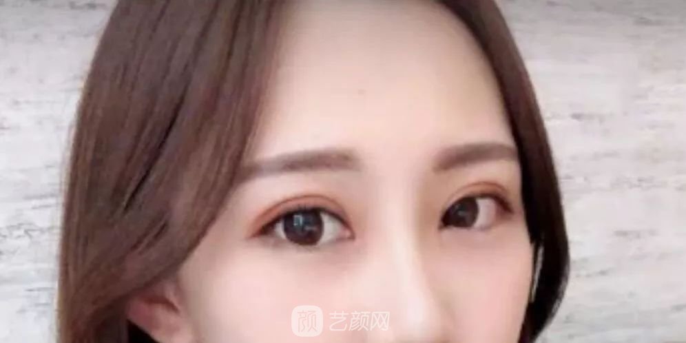 眼部手術(shù)一個月恢復(fù)日記，片分享~