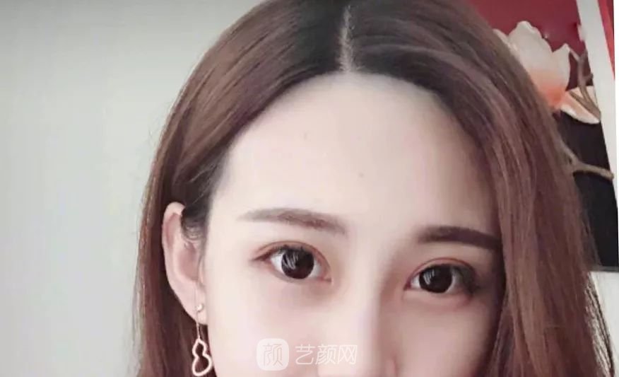 眼部手術(shù)一個月恢復(fù)日記，片分享~
